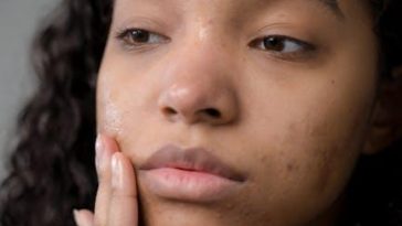 Acne Program– Action 11 Herbal Mixtures To Consume Alcohol