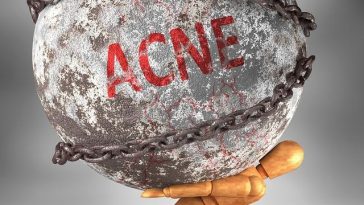 Acne Program – Action 8 Veggies to Consume Alcohol along with eat